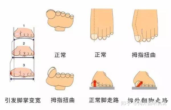 腳拇指外翻最新治療新方法